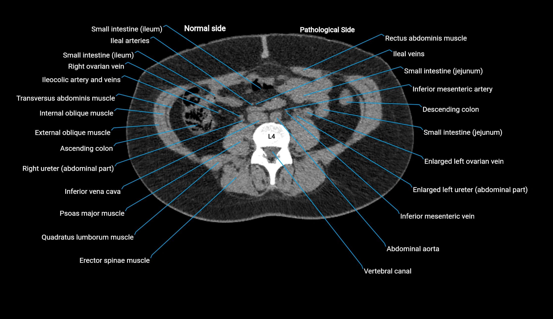 CT KUB axial cross sectional anatomy  radiology image -img-00201-00082.webp